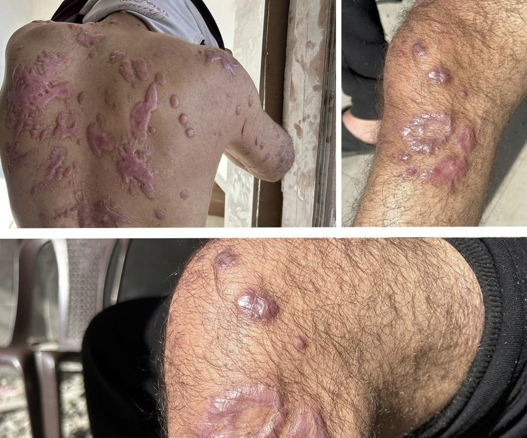 Kisah pilu tahanan Palestina disiram asam dan bahan kimia oleh tentara Israel 1 palestina tahanan